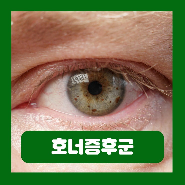  호너증후군 폐암 증상 한쪽 눈 동공 축소 눈꺼풀 처짐 치료