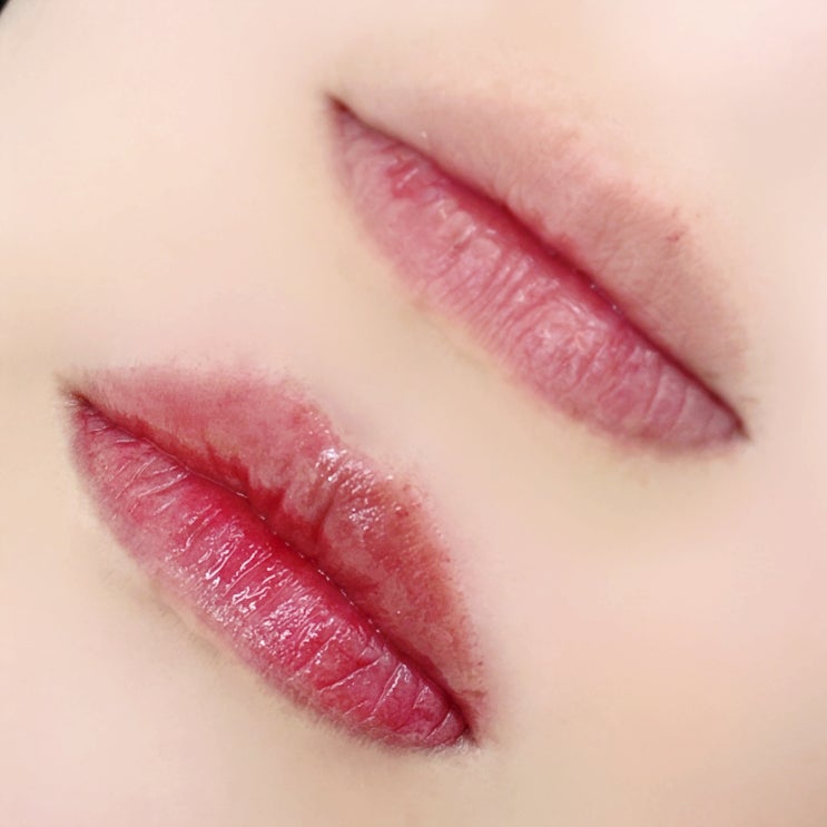  입술필러 대신 무들에서 광주틴트립 비대칭입술 커버