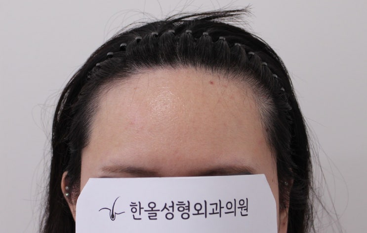  30대 여성 헤어라인 비절개 3000모 2주 경과