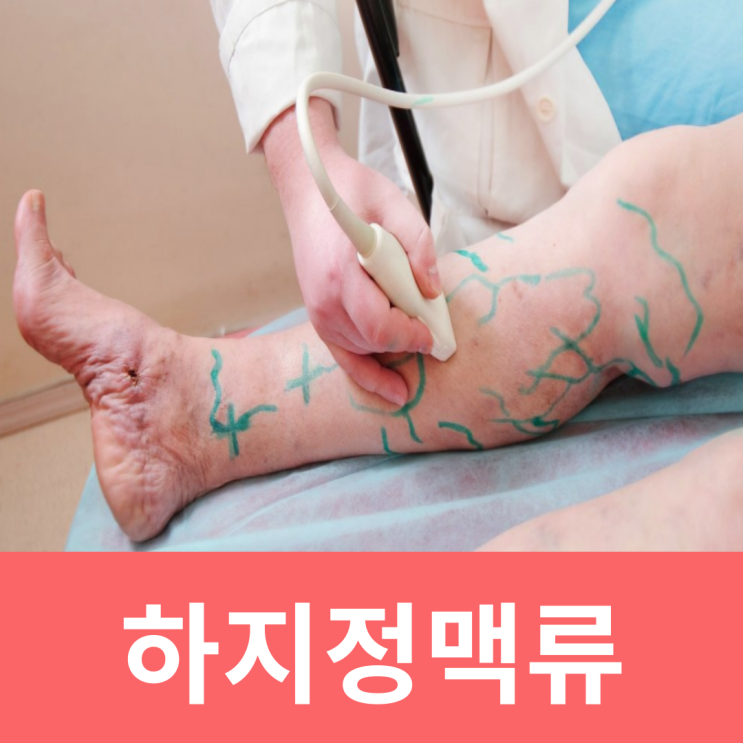  하지정맥류 원인 증상 치료 수술 후 관리 압박스타킹