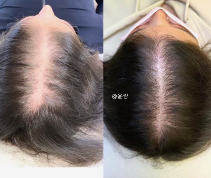  바르는 미녹시딜 부작용 머리발모제 효과