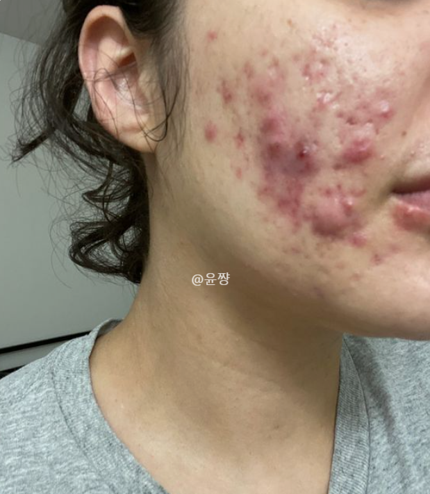 볼 여드름 염증 염증주사 효과 염증성여드름 관리법