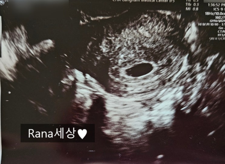  [임신일기] 임신 5주차 아기집 확인 후 출혈로 강남차병원 입원(병실, 비용, 식단 등)