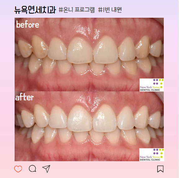  강남역 원데이 치아미백 3회 후기, 횟수, 이시림 증상