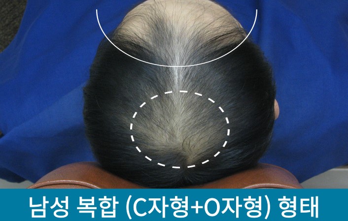  신촌탈모, 급속 진행한 남자 정수리 복합형의 치료사례