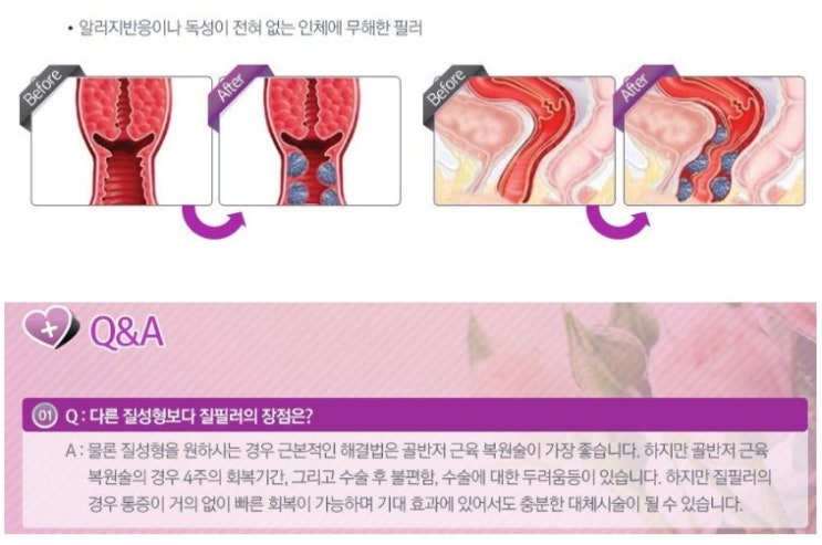  신종 이쁜이 수술