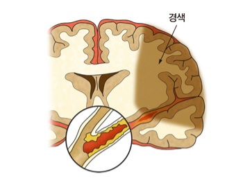  의학용어 의료용어 정리 모음(AV block, PTE, PMC, RFA, CI, AAA)