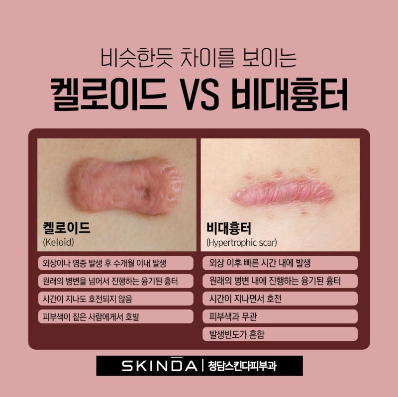 강남 흉터치료 레이저의 안전하고 효과적인 치료법은