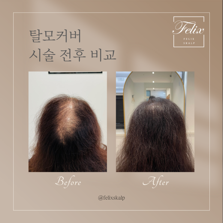  탈모 극복을 위한 선택! 안아픈 풍무동 두피문신 필릭스스칼프