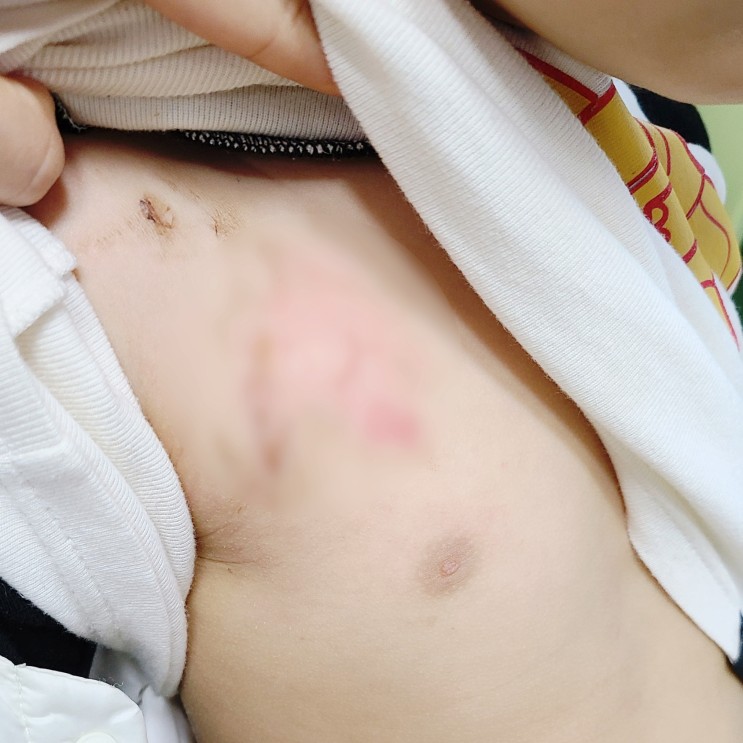 아이 화상 응급처치 : 노스카나 연고 흉터 회복기간 5살의 화상치료