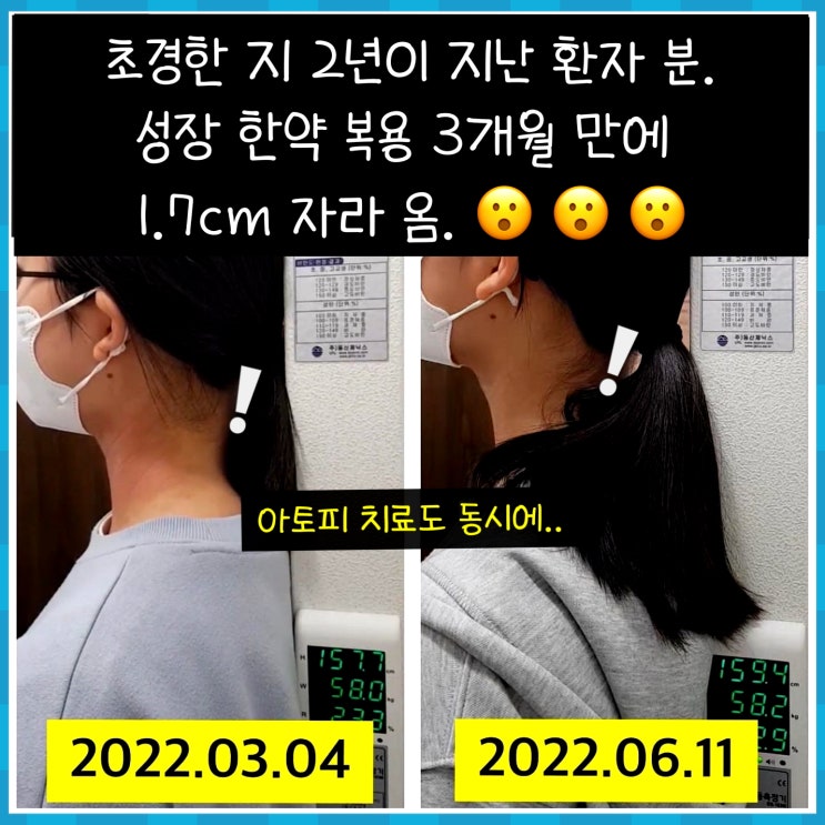  초경 2년 후에 3개월간 1.7cm 성장한 치료 후기