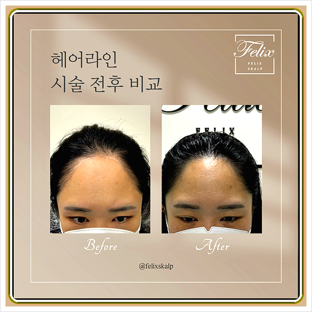  김포 헤어라인 두피문신 실패없고 자연스럽게 잘하는 곳 추천
