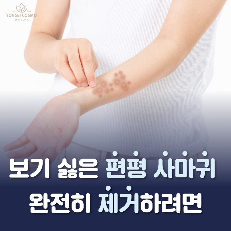  구로피부관리 보기 싫은 편평 사마귀 완전히 제거하려면