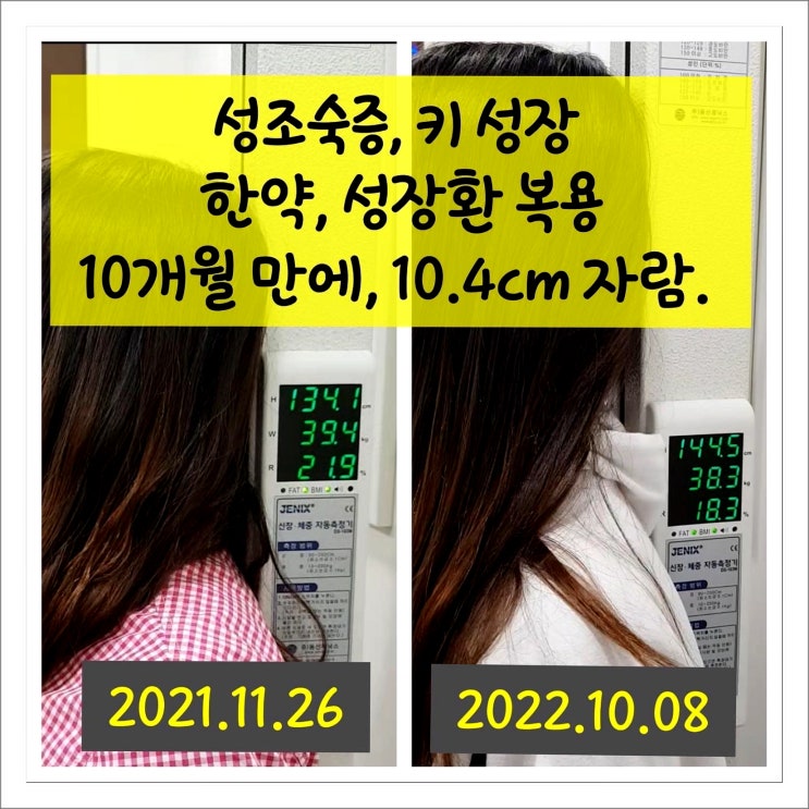  성조숙증 진단 받은 후 성장환 복용으로 10개월 10.4cm 성장