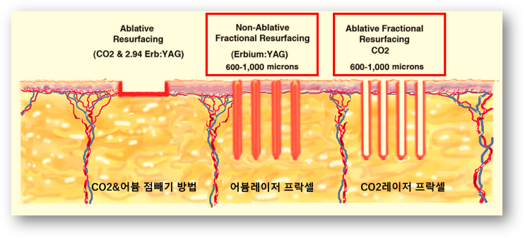  어븀프락셀과 피코프락셀 효과