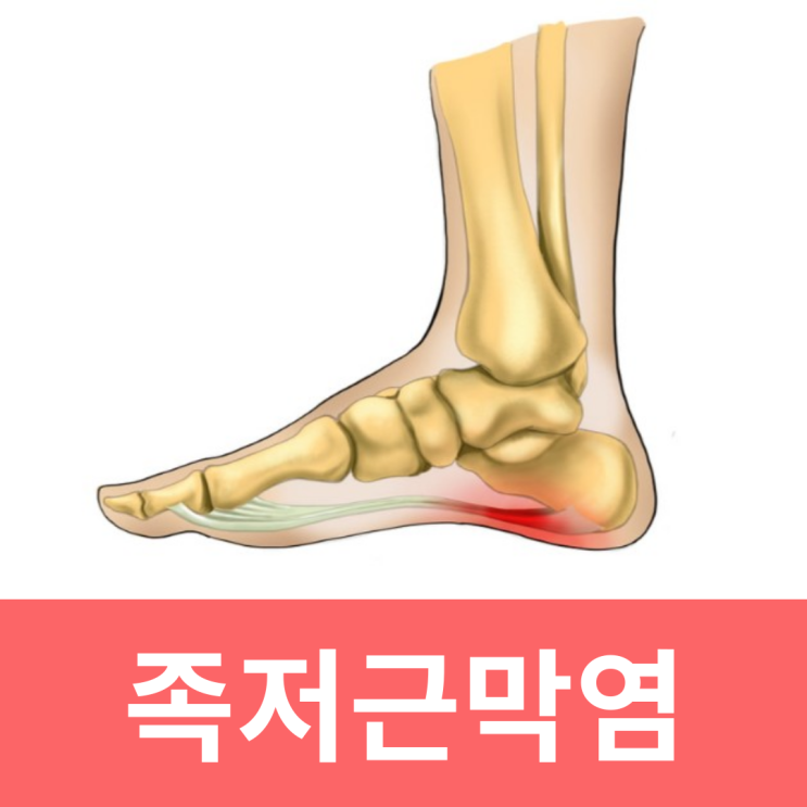  발바닥뒤쪽통증 족저근막염 보호대 패드 원인 치료