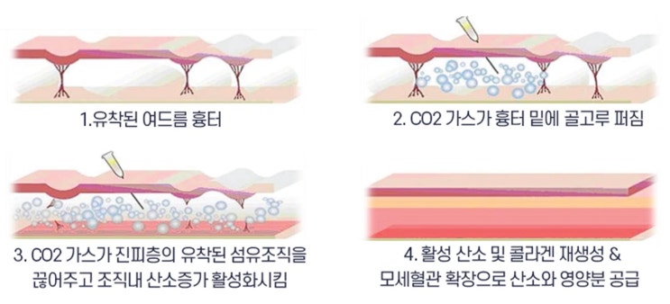  [트리필프로] CO2 분사 효과