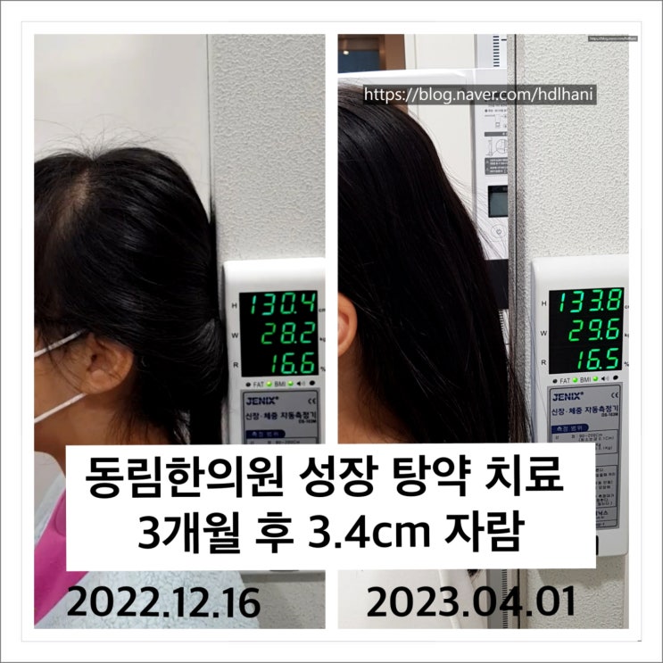  한약으로 키 성장, 아토피가 함께 나아진 사례 후기