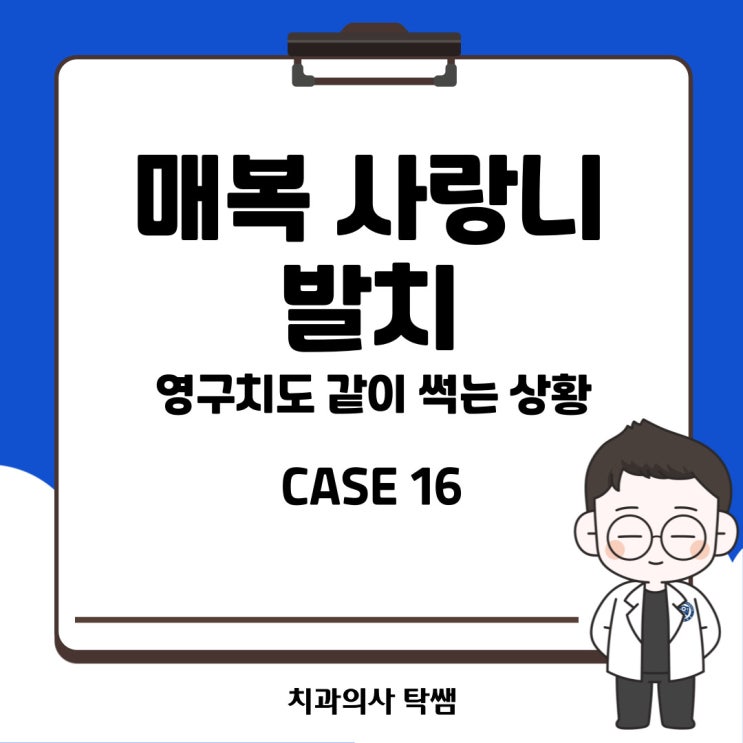  [탁쌤 CASE 16] 매복 사랑니 발치! 인접 영구치에 충치?