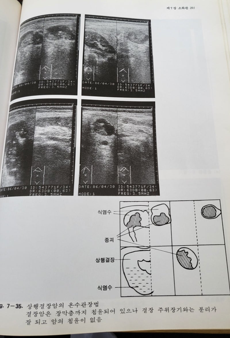 복부 [장폐색, 마비성 장폐쇄, 장중첩증, 대장암, 급성 충수염] 초음파 진단 및 개괄