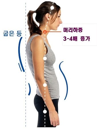  물리 치료만으로 거북목이 치료가 될까?