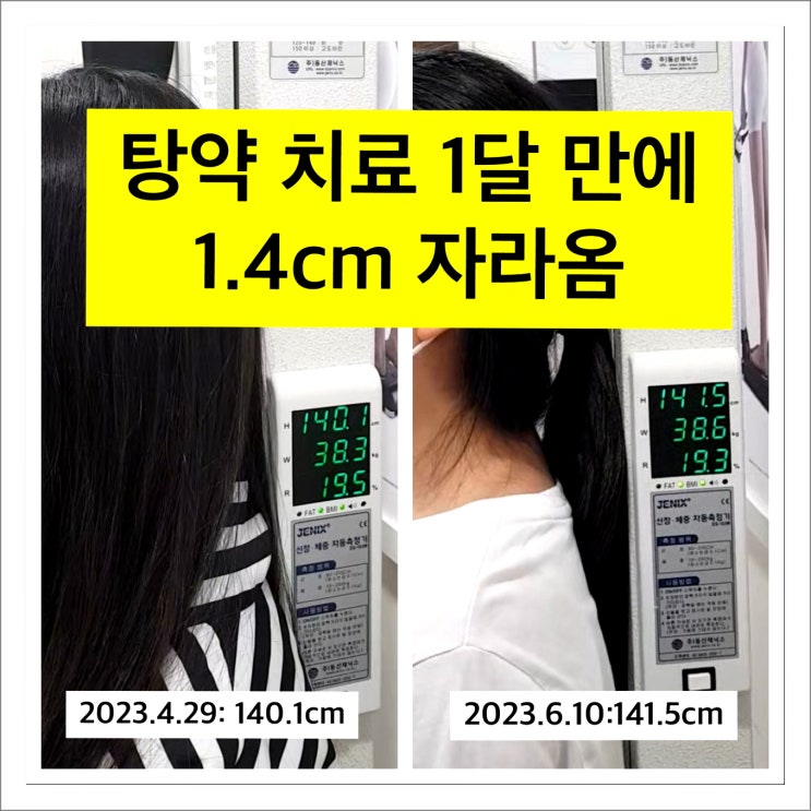  성장 한약 1달 복용으로 1.4cm 성장한 후기