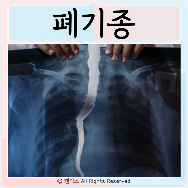 폐기종 원인 증상 폐가 안좋을때 치료방법