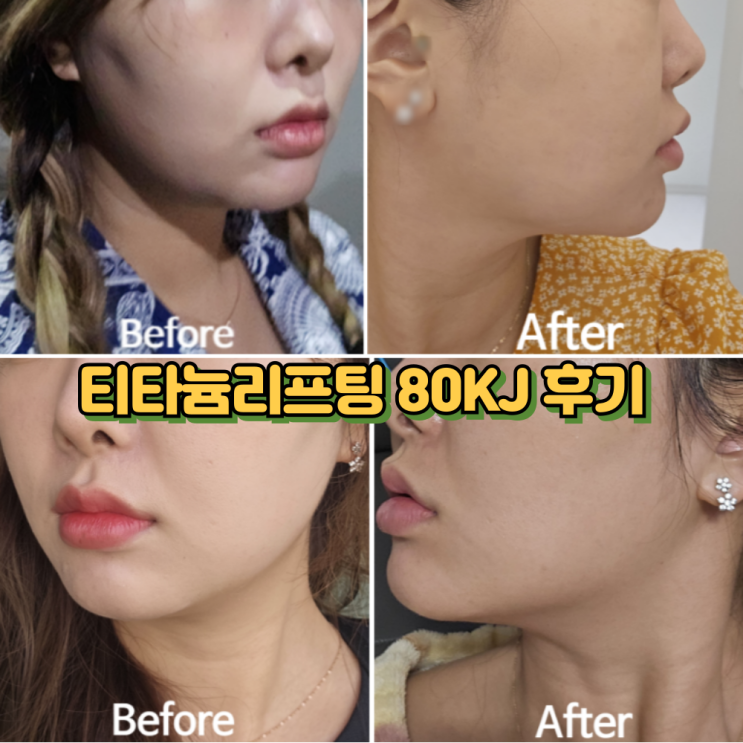  강남피부과 티타늄리프팅 볼꺼짐 땅콩형얼굴 후기