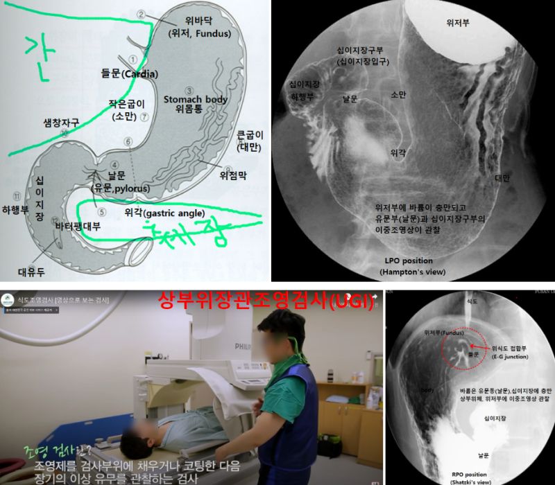 조기위암과 위병변 관찰을 목적으로 하는 상부위장관조영술(UGI, Upper GastroIntestinal Series)