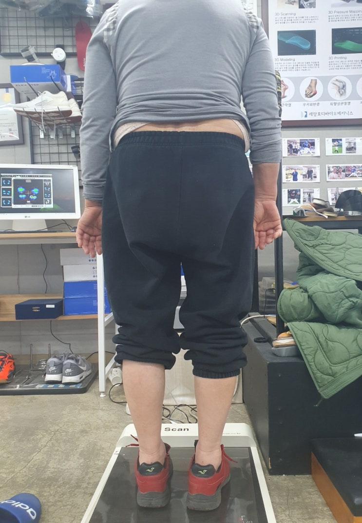 발 앞쪽 통증(지간신경종)과 척추 불안정성, 제대로 된 족부 재활이 필요합니다.