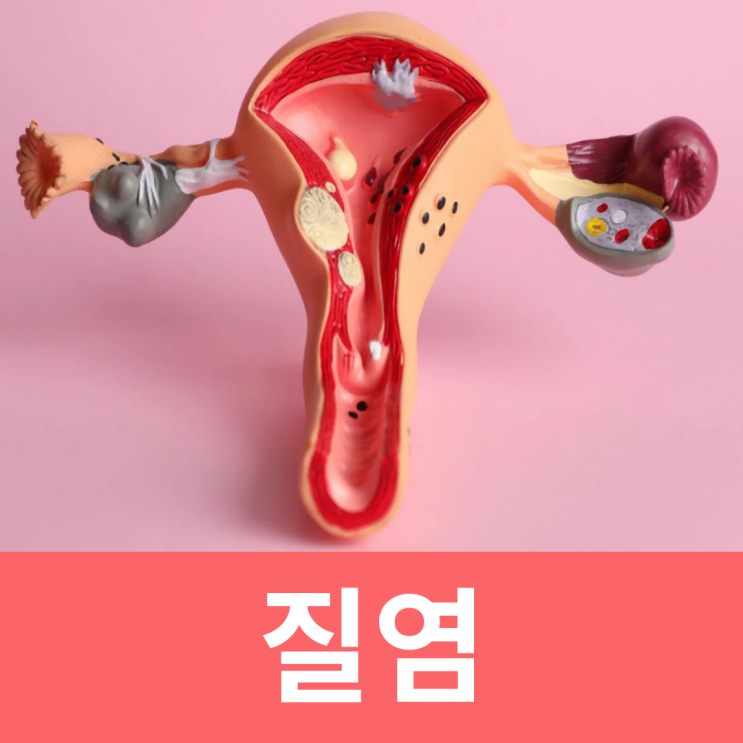  냄새나는질염 만성 급성 질정 방치 원인 증상 관리방법