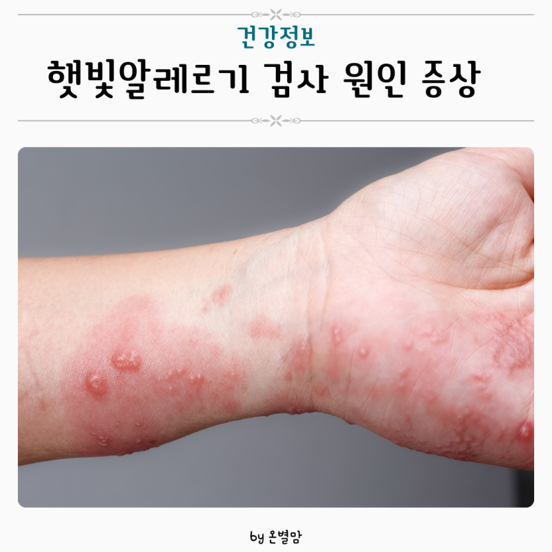 햇빛알레르기 검사 원인 증상 연고 치료방안