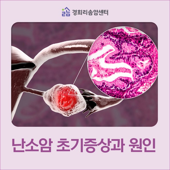 난소암 초기증상과 원인에 관하여. 금천구 암요양병원 경희리솜암센터