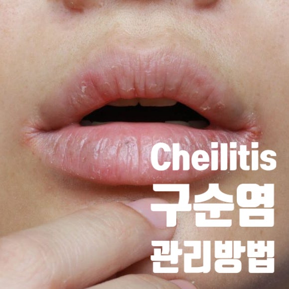  구순염(Cheilitis)의 관리방법