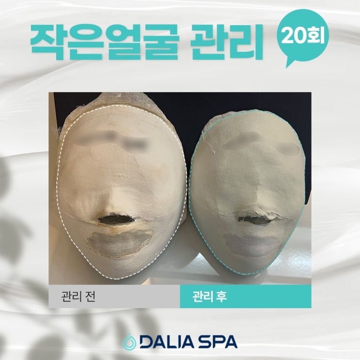  QnA 윤곽주사후 관리받아도 되나요? 윤곽주사 효과있는 얼굴