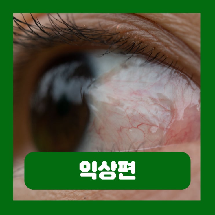  익상편 수술 비용 군날개 초기 증상 눈 질환 원인