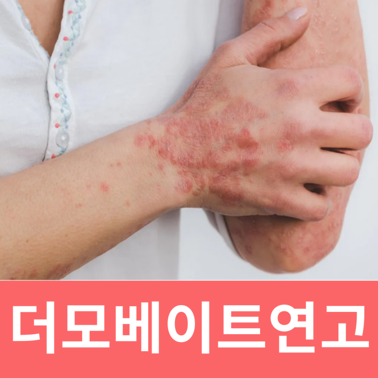  더모베이트연고효능 가격 부작용 정리