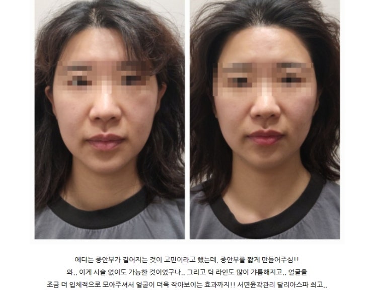  서면윤곽관리 - 작은얼굴 관리는 달리아스파!! 재방문후기 by.eddy