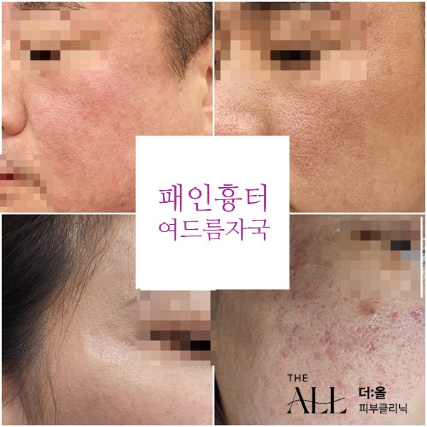  안산큐어젯 여드름 아이스픽 패인흉터 탈모치료 쥬베룩 엑소좀 줄기세포치료
