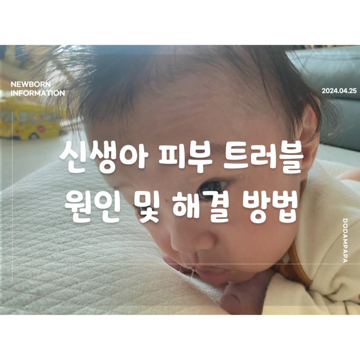 신생아 피부 트러블 원인 및 해결 방법 신생아 여드름 신생아 피부 트러블 원인 및 해결 방법 신생아 여드름