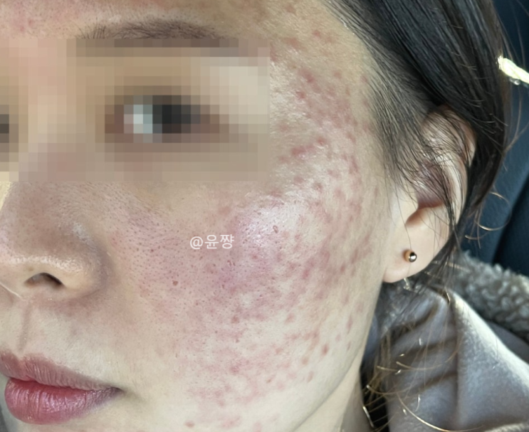  피부과 피부관리 좁쌀 여드름 압출 후 관리 1년 변화
