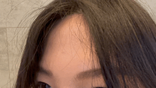 홍대 흉터치료 수두자국제거 새살침 4회차 후기 홍대 흉터치료 수두자국제거 새살침 4회차 후기