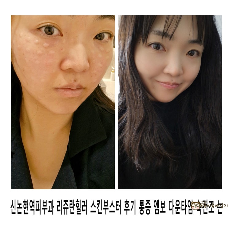  신논현역피부과 리쥬란힐러 스킨부스터 후기 통증 엠보 다운타임 속건조 는