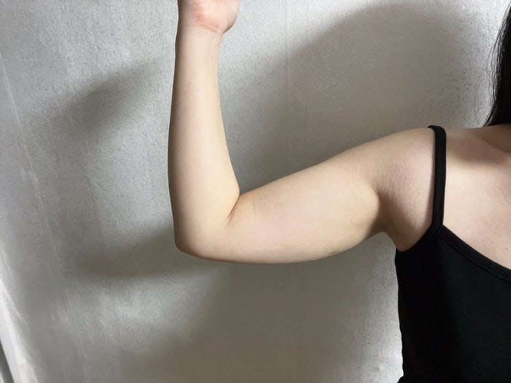  광주 지방분해주사 팔뚝살 맞고온 후기 입니다요