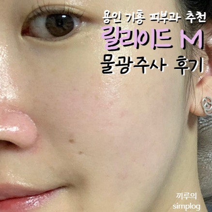  [내돈내산] 용인 기흥 피부과 추천 : 릴리이드M 물광주사 5cc 후기/엠보/가격(+프락셀)
