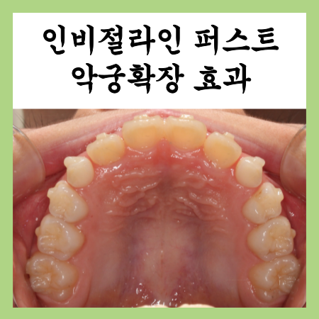  어린이 부정교합 인비절라인 퍼스트로 악궁확장 중간평가