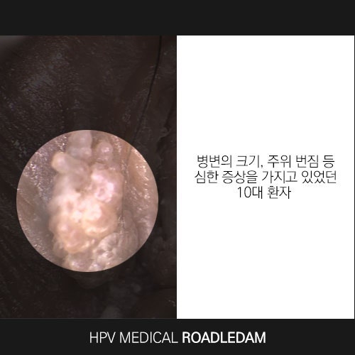 남성 곤지름 사진 및 치료 모음.ZIP
