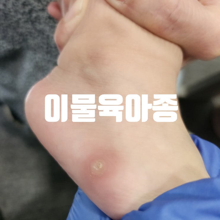  아이 발 피부의 덩어리가 안없어져요... 이물육아종 (Foreign body granuloma)