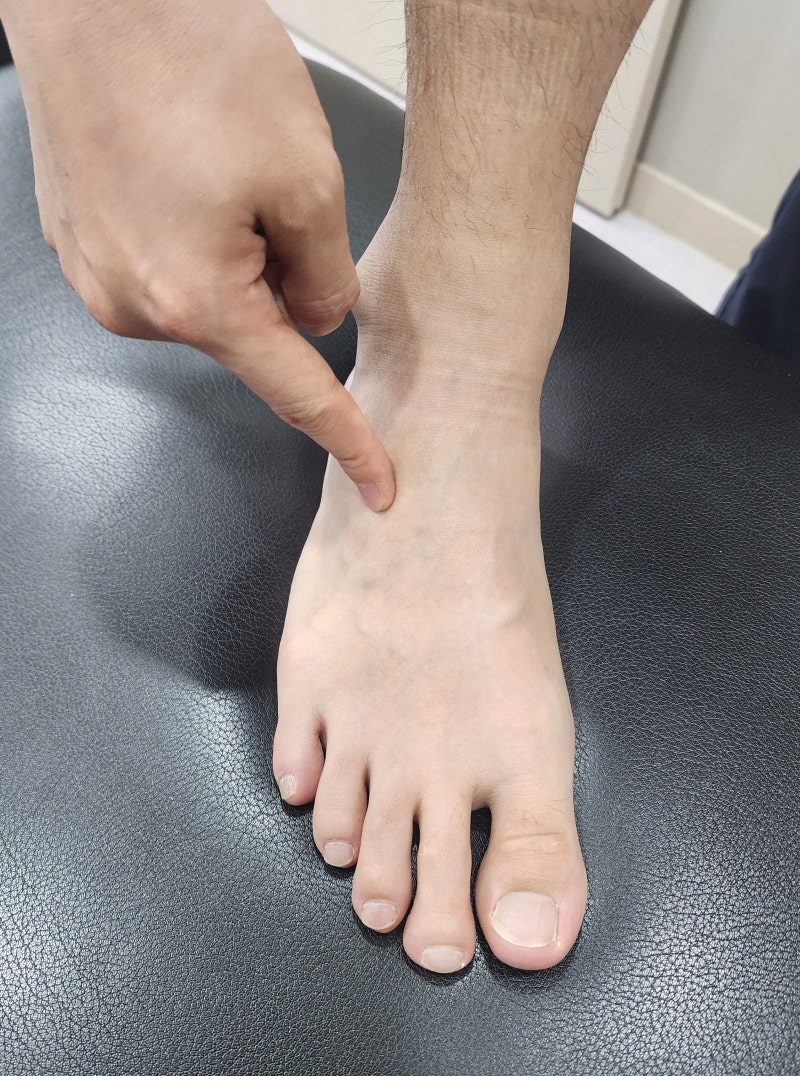 발등 통증 - 장지신근 건초염 / 망치발가락(hammertoe)