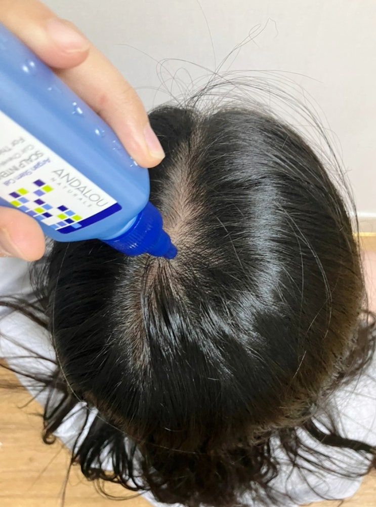  안달로우 내추럴스 두피에센스 지루성두피염 두피영양제 사용법